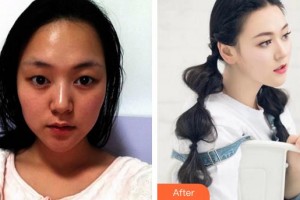 廈門大學(xué)附屬廈門眼科中心醫(yī)院陳惠嬋整形價格表附雙眼皮案例展示