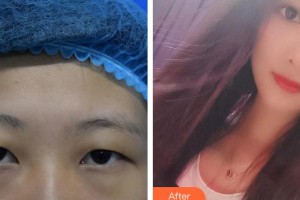 廈門大學(xué)附屬廈門眼科中心醫(yī)院王曉波整形價格表附眼部手術(shù)案例展示