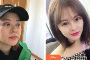 廈門大學(xué)附屬廈門眼科中心醫(yī)院吳東海整形價格表附胎生隱形雙眼皮修復(fù)案例展示