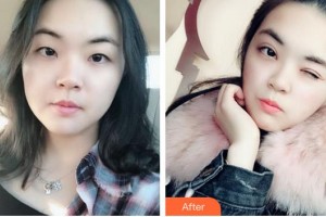 廈門大學(xué)附屬廈門眼科中心醫(yī)院陳亮整形價格表附眼部整形案例展示