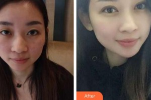 廈門大學(xué)附屬廈門眼科中心醫(yī)院李明翰整形價格表附雙眼皮案例展示