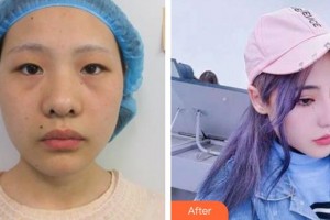 廈門大學(xué)附屬廈門眼科中心醫(yī)院黃維藝整形價格表附眼部綜合案例展示