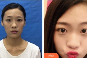 廈門大學(xué)附屬廈門眼科中心醫(yī)院鄧坤明整形價格表附眼部綜合案例展示