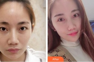 廈門大學(xué)附屬廈門眼科中心醫(yī)院鄭林整形價格表附定點雙眼皮案例展示