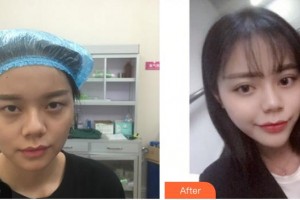 廈門大學(xué)附屬廈門眼科中心醫(yī)院李瑞霞整形價格表附眼部手術(shù)案例展示