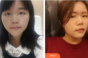 廈門市第二醫(yī)院美容整形外科中心肖磊整形價格表附眼睛改變小記錄案例展示