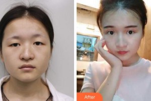 廈門大學(xué)附屬廈門眼科中心醫(yī)院史小玲整形價格表附切開雙眼皮 媚眼如絲案例展示