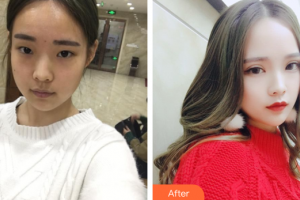 廣州麗尚整形美容門診部艾澤整形價(jià)格表附眼部手術(shù)案例展示