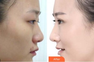 廈門大學(xué)附屬廈門眼科中心醫(yī)院林青鴻整形價格表附眼部整形案例展示