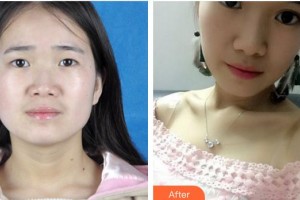 廈門大學(xué)附屬廈門眼科中心醫(yī)院吳媛整形價格表附雙眼皮案例展示