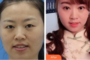 廈門大學(xué)附屬廈門眼科中心醫(yī)院陳彥茹整形價格表附眼部案例展示