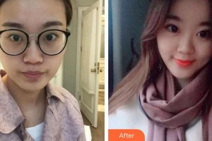 廈門大學(xué)附屬廈門眼科中心醫(yī)院劉今坤住院醫(yī)師整形價格表附切開雙眼皮案例展示