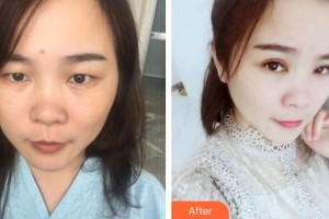 廈門大學(xué)附屬廈門眼科中心醫(yī)院陳龍龍住院醫(yī)師整形價格表附眼部整形案例展示