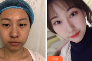 廈門大學(xué)附屬廈門眼科中心醫(yī)院況坤整形價格表附雙眼皮+內(nèi)外眼角案例展示