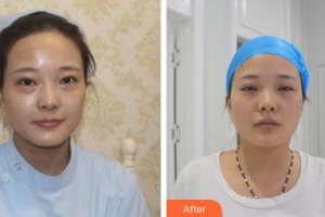 廈門大學(xué)附屬?gòu)B門眼科中心醫(yī)院吳錦熙住院醫(yī)師整形價(jià)格表附不開刀祛眼袋案例展示