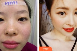 廈門大學(xué)附屬?gòu)B門眼科中心醫(yī)院潘桔昕住院醫(yī)師整形價(jià)格表附帕克雙眼皮+開內(nèi)眼角案例展示