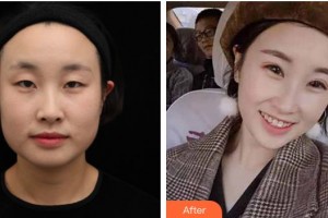 廈門科宏眼科醫(yī)院張美洪整形價(jià)格表附全切雙眼皮案例展示