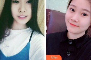 廈門科宏眼科醫(yī)院陳珊娜整形價(jià)格表附韓式切開雙眼皮案例展示