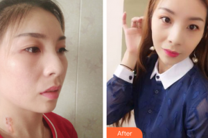 廣州愛來（原阿瑪施）醫(yī)療美容整形醫(yī)院肖和整形價(jià)格表附微創(chuàng)疤痕修復(fù)案例展示