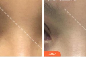 廈門科宏眼科醫(yī)院鄭麗梅整形價(jià)格表附全切雙眼皮案例展示