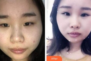 廈門科宏眼科醫(yī)院李淑琴整形價(jià)格表附眼部整形案例展示