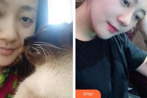 廈門科宏眼科醫(yī)院王璟琪整形價(jià)格表附切開雙眼皮案例展示