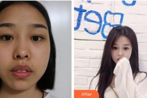 廈門科宏眼科醫(yī)院曾云暖整形價(jià)格表附全切雙眼皮+開眼角案例展示