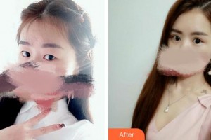 廈門科宏眼科醫(yī)院黃磊整形價(jià)格表附雙眼皮案例展示