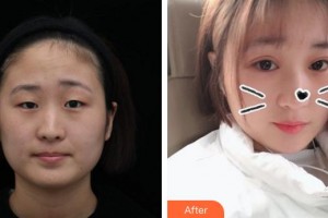 廈門市海滄醫(yī)院眼科張萌整形價(jià)格表附眼部手術(shù)案例展示