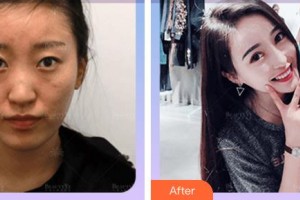 廈門市海滄醫(yī)院眼科馬榕整形價(jià)格表附切開雙眼皮案例展示