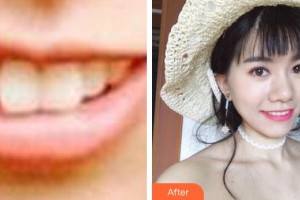 廈門拜博口腔醫(yī)院張忠整形價(jià)格表附牙齒矯正案例展示