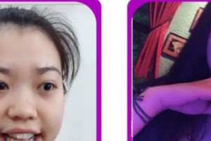 廈門醫(yī)學(xué)院附屬口腔醫(yī)院胡硯平整形價(jià)格表附牙齒隱形矯正案例展示