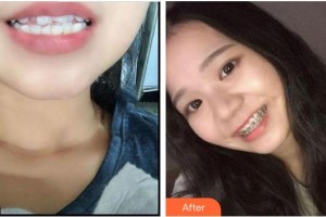 廈門鉑菲特口腔門診部鄭美玲整形價(jià)格表附金屬托槽矯正案例展示