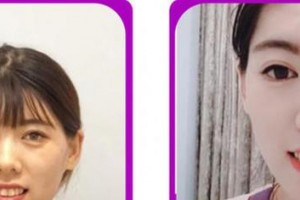 廈門峰煜口腔門診部曹尚軍整形價(jià)格表附牙齒隱形矯正案例展示