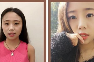 廈門現(xiàn)代口腔門診部耿繼紅整形價(jià)格表附牙齒隱形矯正案例展示