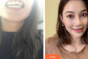 廈門麥芽口腔醫(yī)院姚江武整形價(jià)格表附半隱形矯正案例展示