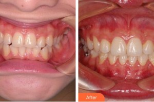 莆田海峽整形美容醫(yī)院孟憲文整形價(jià)格表附牙齒正畸案例展示