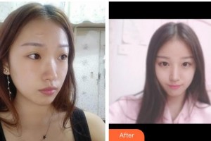 莆田婦產(chǎn)專科醫(yī)院瑞麗醫(yī)療美容科林必華整形價(jià)格表附手術(shù)縫合祛疤案例展示