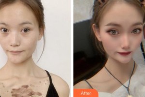 莆田婦產(chǎn)?？漆t(yī)院瑞麗醫(yī)療美容科陳小青整形價(jià)格表附疤痕疙瘩案例展示