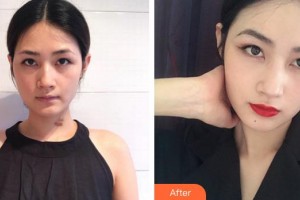 莆田明韓女人花整形美容診所吳建超整形價(jià)格表附增生疤痕案例展示