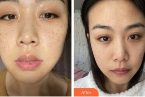 莆田海峽整形美容醫(yī)院陳秀華整形價格表附激光美膚激光案例展示