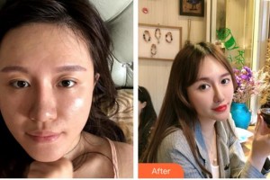 莆田維納斯整形美容門診部時慧整形價格表附埋線提升案例展示