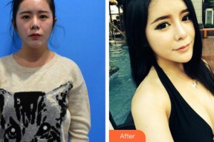 莆田海峽整形美容醫(yī)院林寅整形價格表附胸部案例展示