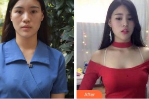 莆田瑞麗整形美容醫(yī)院吳炳為住院醫(yī)師整形價格表附自體脂肪隆胸案例展示