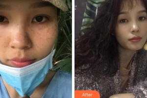 莆田瑞麗整形美容醫(yī)院呂娜住院醫(yī)師整形價格表附雙激光美膚案例展示