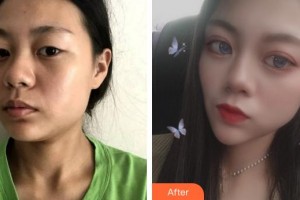 莆田華廈眼科醫(yī)院廖麗紅整形價格表附洛麗塔美眼案例展示