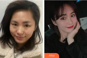 莆田華廈眼科醫(yī)院詹桂林整形價格表附眼部綜合案例展示