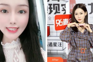 莆田雅美佳口腔醫(yī)院陳亞妹整形價格表附隱形矯正案例展示