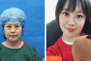 莆田華廈眼科醫(yī)院宋昊剛整形價格表附不開刀祛眼袋+自體脂肪填充淚案例展示