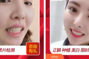 莆田群益口腔門診部劉宗錦整形價(jià)格表附牙齒做美容案例展示